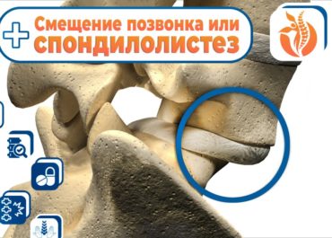 Смещение позвонка или Спондилолистез