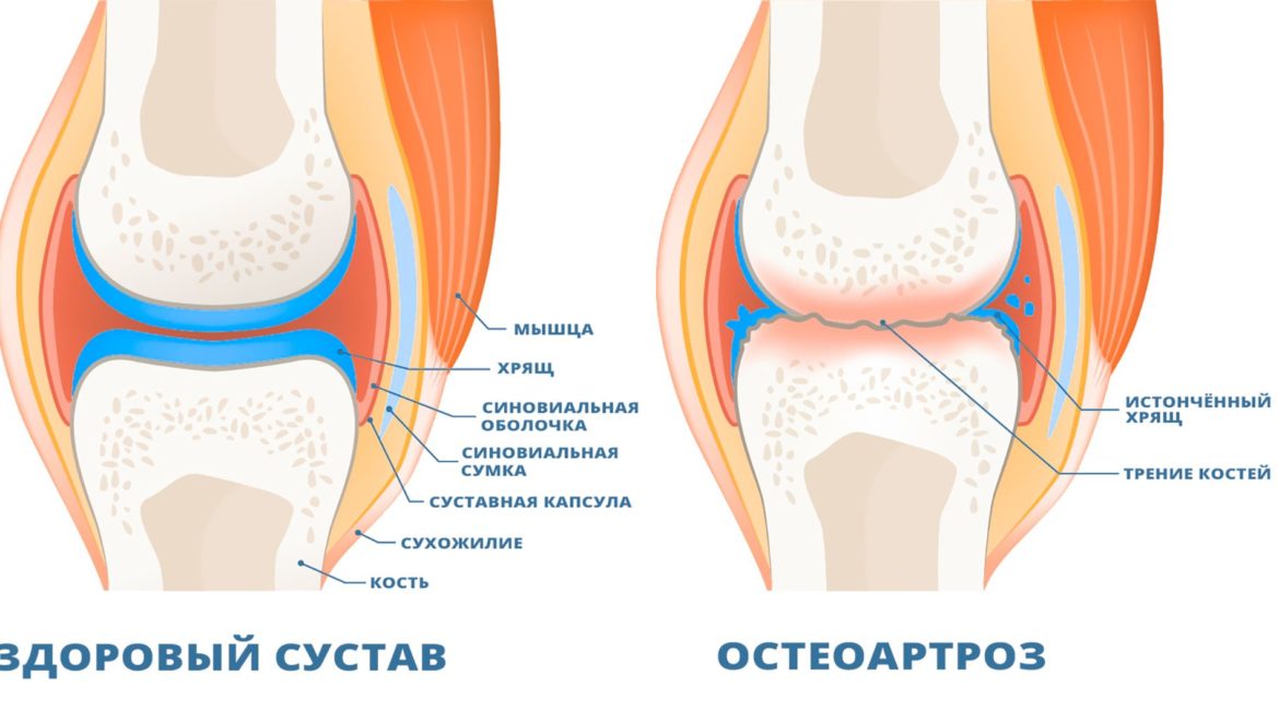 Остеоартроз суставов