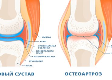 Остеоартроз суставов